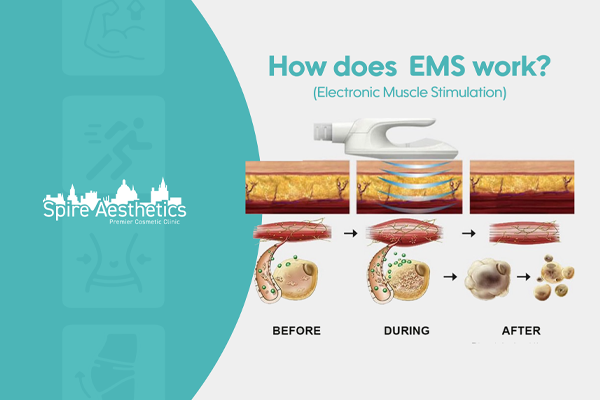 EMS treatment for post pregnancy weight loss treatment Scotland