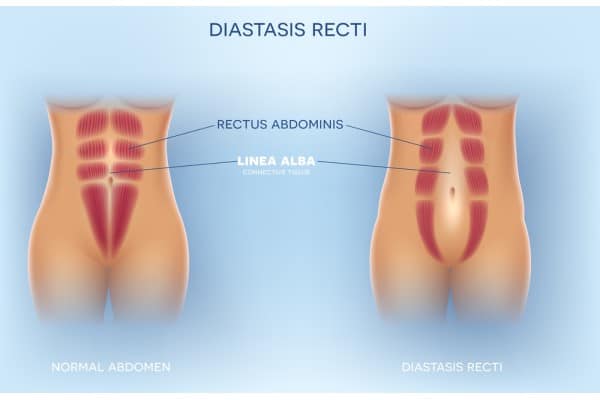 What Non-Surgical Options Are Available for Diastasis Recti Scotland?
