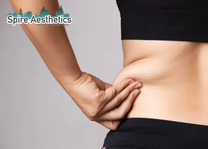Image of woman pinching fat on their hips Scotland. Fat Freezing treatment