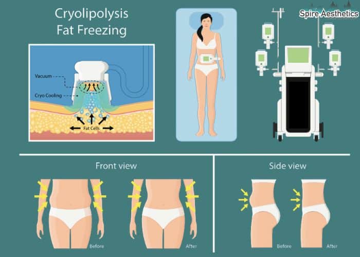 Image of diet and fat freezing combined for best results for Spire Aesthetics Scotland