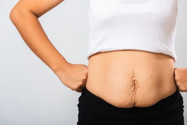 Image of a woman's stomach after weight loss with sagging skin following a gastric band Scotland