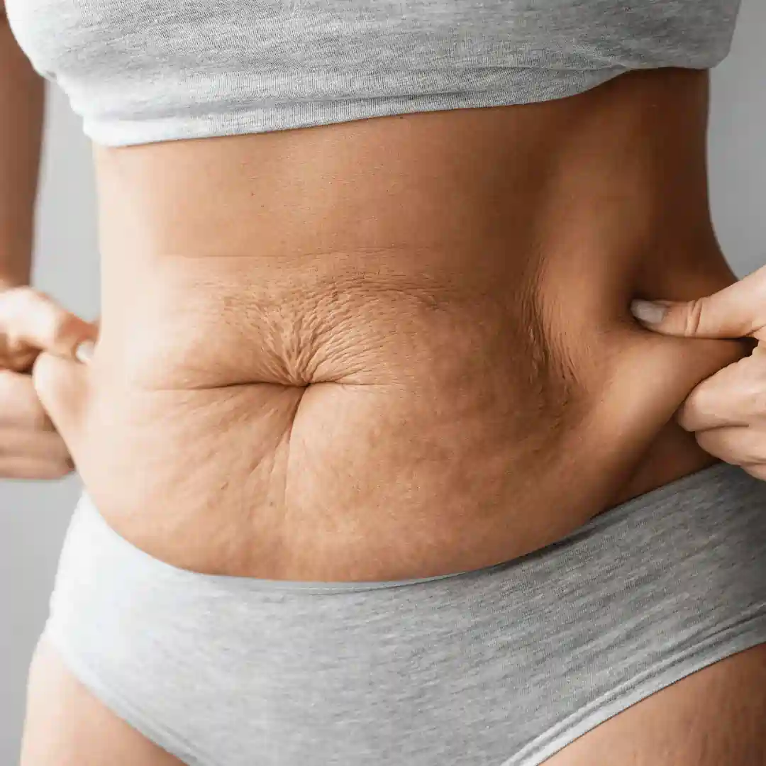 Is It Normal to Have Loose Skin After Pregnancy Scotland?