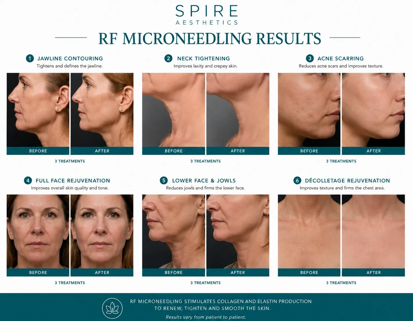 RF Microneedling Skin tightening Scotland results