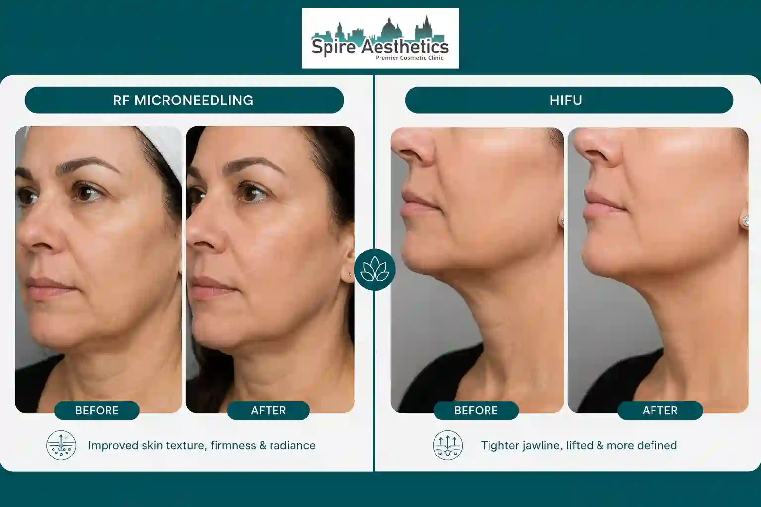 Can RF Microneedling and HIFU Be Combined Scotland?