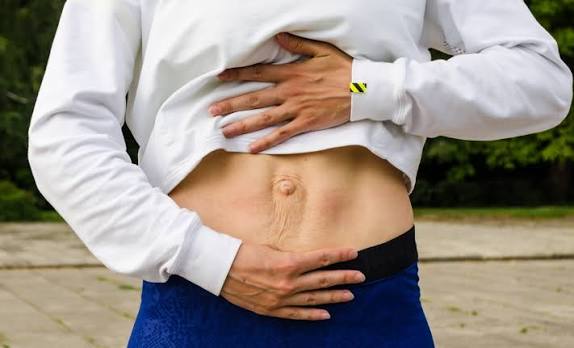 When Could Diastasis Recti Be the Missing Piece of the Puzzle Scotland?