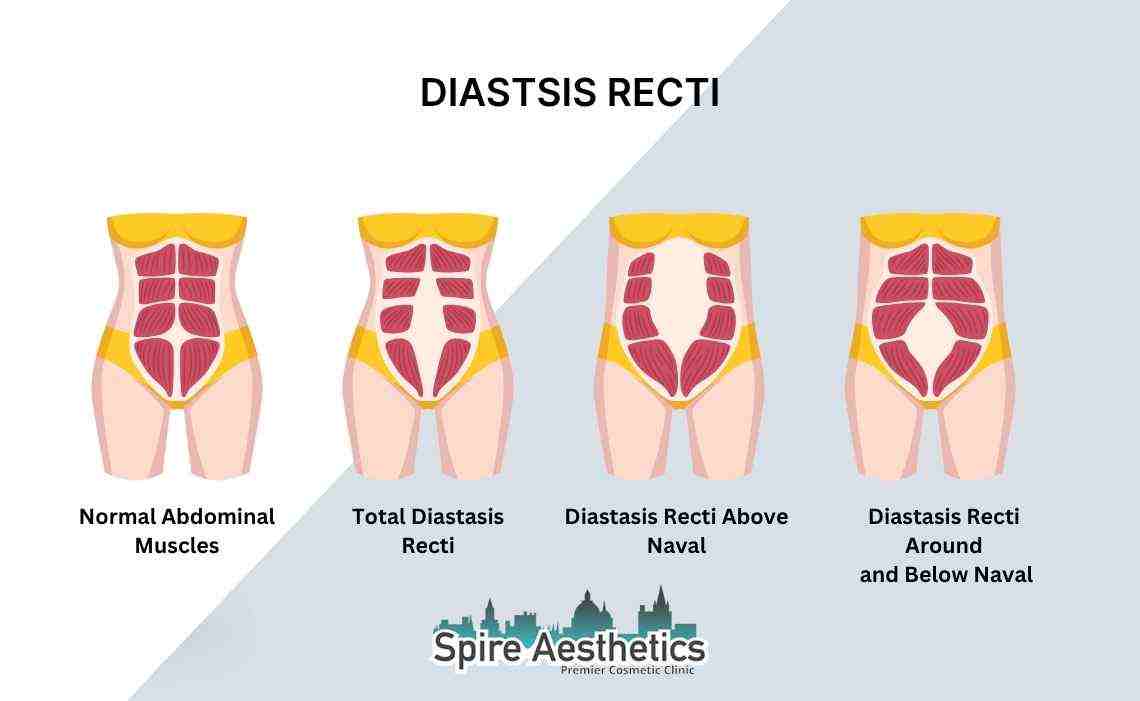 Is Non-Surgical Diastasis Recti Treatment Right for You? Common Concerns Answered Scotland